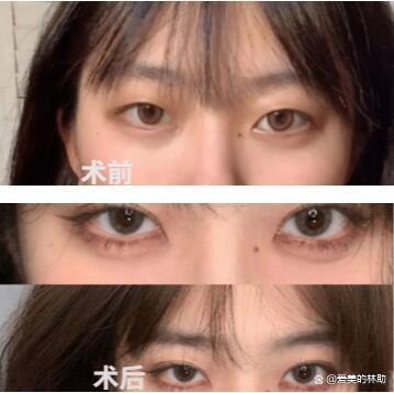 广州有没有好的割双眼皮的医生推荐?2023年超级干货,内含案